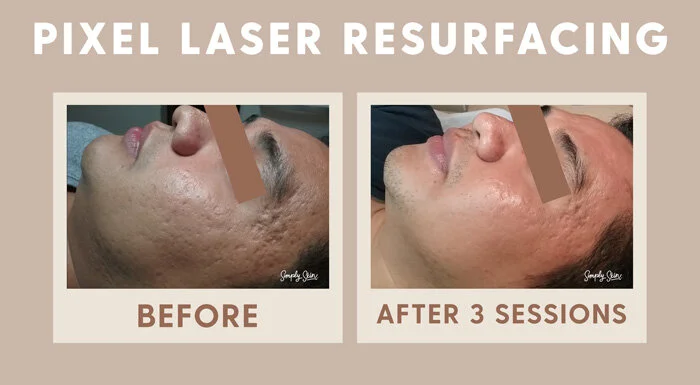 Why Try Pixel Laser Resurfacing Simply Skin